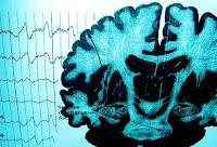 Nuevo Tratamiento para el Autismo y la Epilepsia Nuevo Tratamiento para el Autismo y la Epilepsia