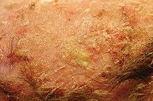 ¿Qué es la queratosis actínica?