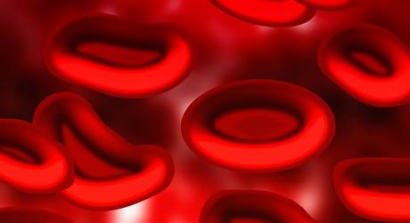 Anemia Hemolítica Autoinmune