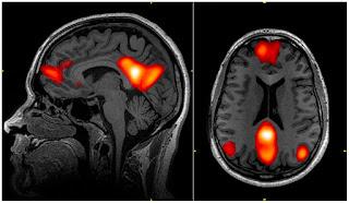 ¿Cuáles son las partes del cerebro asociadas al sueño?