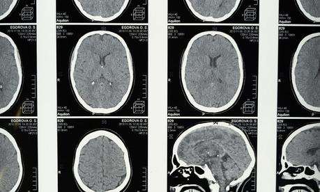 ¿Cuáles son las partes del cerebro asociadas al sueño?