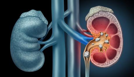 medicina natural para los calculos renales