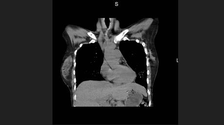 CASO CLINICO DE NEUMONITIS POR HIPERSENSIBILIDAD