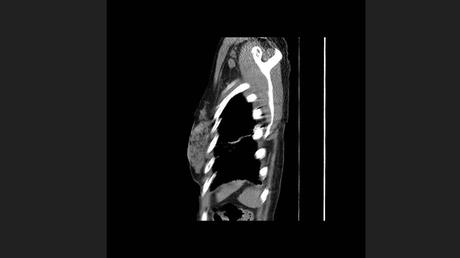CASO CLINICO DE NEUMONITIS POR HIPERSENSIBILIDAD