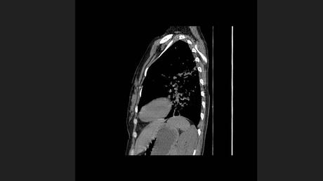 CASO CLINICO DE NEUMONITIS POR HIPERSENSIBILIDAD