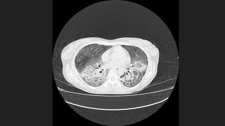 CASO CLINICO DE NEUMONITIS POR HIPERSENSIBILIDAD