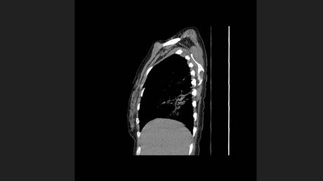 CASO CLINICO DE NEUMONITIS POR HIPERSENSIBILIDAD