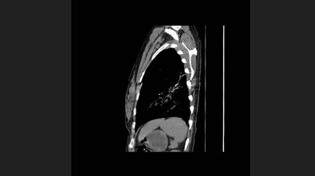 CASO CLINICO DE NEUMONITIS POR HIPERSENSIBILIDAD