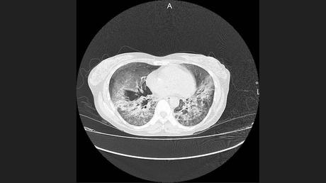 CASO CLINICO DE NEUMONITIS POR HIPERSENSIBILIDAD