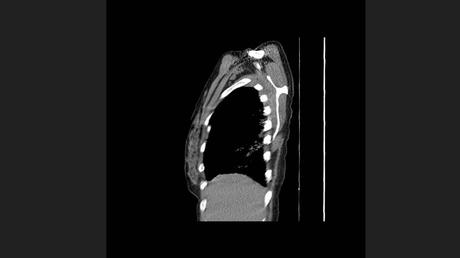 CASO CLINICO DE NEUMONITIS POR HIPERSENSIBILIDAD