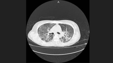 CASO CLINICO DE NEUMONITIS POR HIPERSENSIBILIDAD