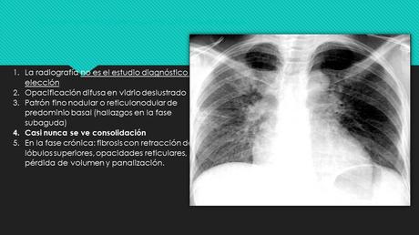 CASO CLINICO DE NEUMONITIS POR HIPERSENSIBILIDAD
