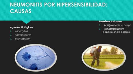 CASO CLINICO DE NEUMONITIS POR HIPERSENSIBILIDAD