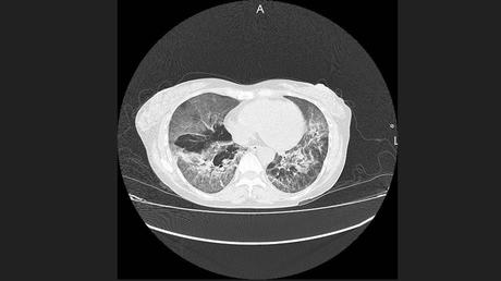 CASO CLINICO DE NEUMONITIS POR HIPERSENSIBILIDAD