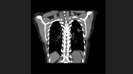 CASO CLINICO DE NEUMONITIS POR HIPERSENSIBILIDAD