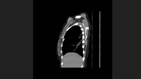 CASO CLINICO DE NEUMONITIS POR HIPERSENSIBILIDAD