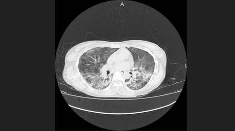 CASO CLINICO DE NEUMONITIS POR HIPERSENSIBILIDAD