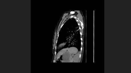 CASO CLINICO DE NEUMONITIS POR HIPERSENSIBILIDAD