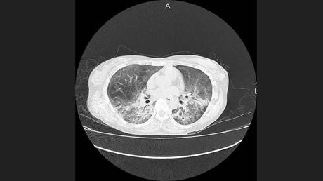 CASO CLINICO DE NEUMONITIS POR HIPERSENSIBILIDAD