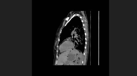 CASO CLINICO DE NEUMONITIS POR HIPERSENSIBILIDAD