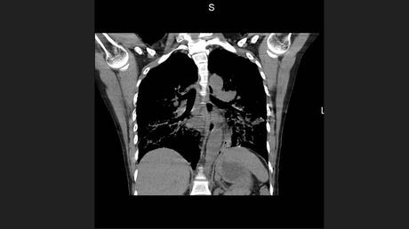 CASO CLINICO DE NEUMONITIS POR HIPERSENSIBILIDAD