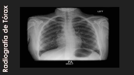 CASO CLINICO DE NEUMONITIS POR HIPERSENSIBILIDAD