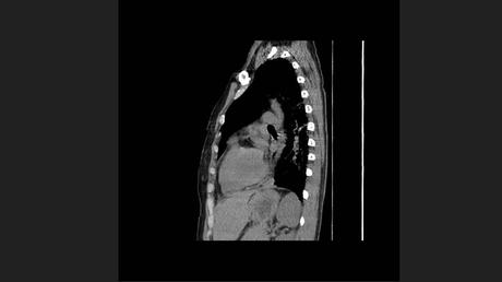 CASO CLINICO DE NEUMONITIS POR HIPERSENSIBILIDAD