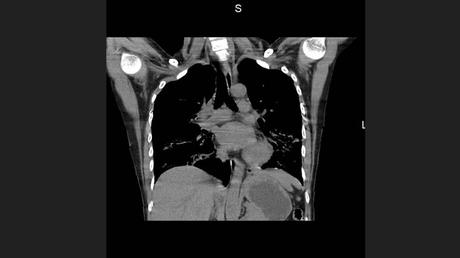 CASO CLINICO DE NEUMONITIS POR HIPERSENSIBILIDAD