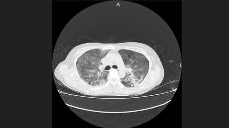 CASO CLINICO DE NEUMONITIS POR HIPERSENSIBILIDAD