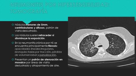 CASO CLINICO DE NEUMONITIS POR HIPERSENSIBILIDAD