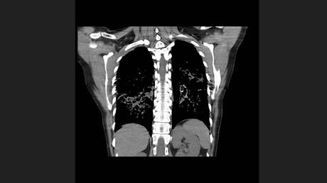 CASO CLINICO DE NEUMONITIS POR HIPERSENSIBILIDAD