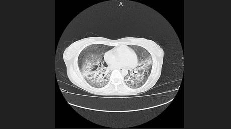 CASO CLINICO DE NEUMONITIS POR HIPERSENSIBILIDAD