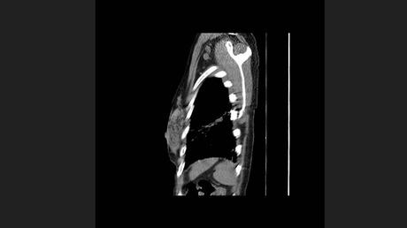 CASO CLINICO DE NEUMONITIS POR HIPERSENSIBILIDAD
