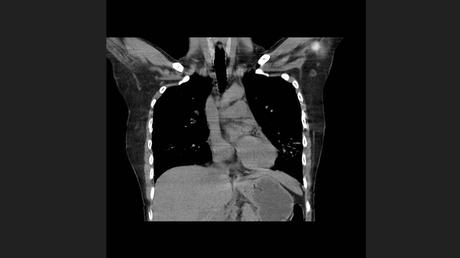 CASO CLINICO DE NEUMONITIS POR HIPERSENSIBILIDAD