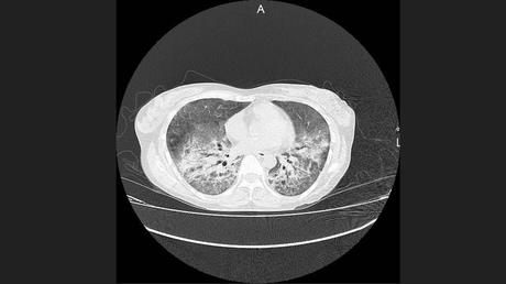 CASO CLINICO DE NEUMONITIS POR HIPERSENSIBILIDAD