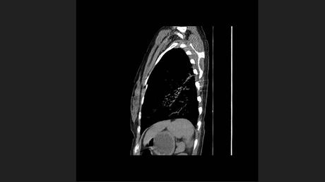 CASO CLINICO DE NEUMONITIS POR HIPERSENSIBILIDAD