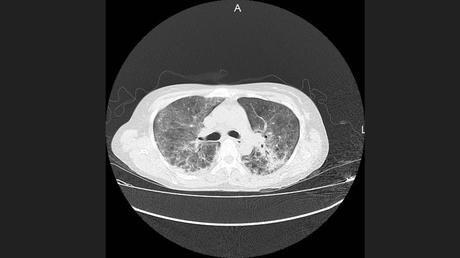 CASO CLINICO DE NEUMONITIS POR HIPERSENSIBILIDAD