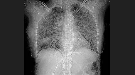 CASO CLINICO DE NEUMONITIS POR HIPERSENSIBILIDAD