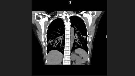 CASO CLINICO DE NEUMONITIS POR HIPERSENSIBILIDAD