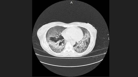 CASO CLINICO DE NEUMONITIS POR HIPERSENSIBILIDAD