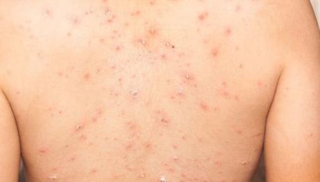 Viróloga asegura que viruela del mono no representa un peligro para Venezuela