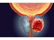 Terapia combinada mejora cáncer Próstata