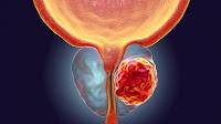 La Terapia combinada mejora el cáncer de Próstata
