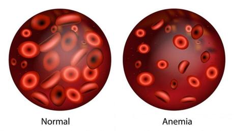 medicina natural para la anemia