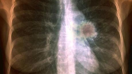 Por medio del aliento pueden diagnosticar cáncer de pulmón Por medio del aliento pueden diagnosticar cáncer de pulmón