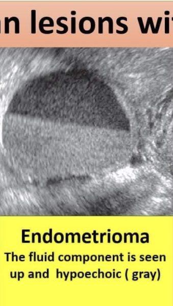 quiste hemorrágico endometrioma El componente líquido se ve arriba e hipoecoico (gris) El componente fluido se ve arriba y negro (anecoico)
