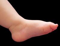 Pies planos en el niño pequeño. Una preocupación innecesaria