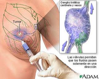 Utilización de la biopsia mamaria mínimamente invasiva para la evaluación de lesiones sospechosas en la mama