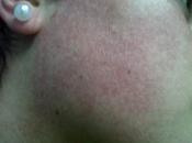 Queratosis Pilar