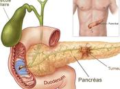 Cáncer páncreas: factores riesgo